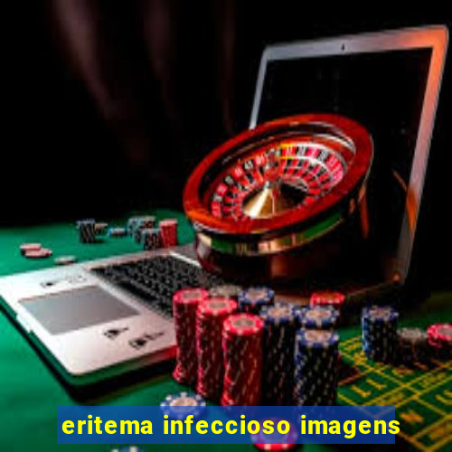 eritema infeccioso imagens